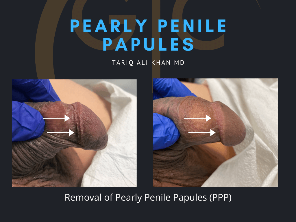 Gentle Care Laser Tustin Before and After picture - pearly penile papules